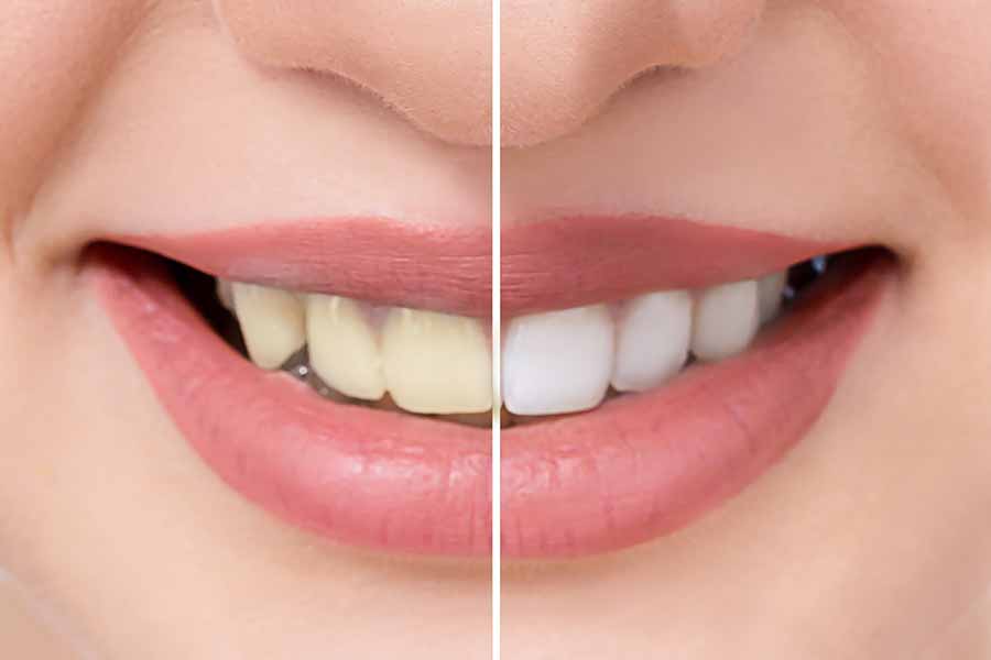 Teeth whitening